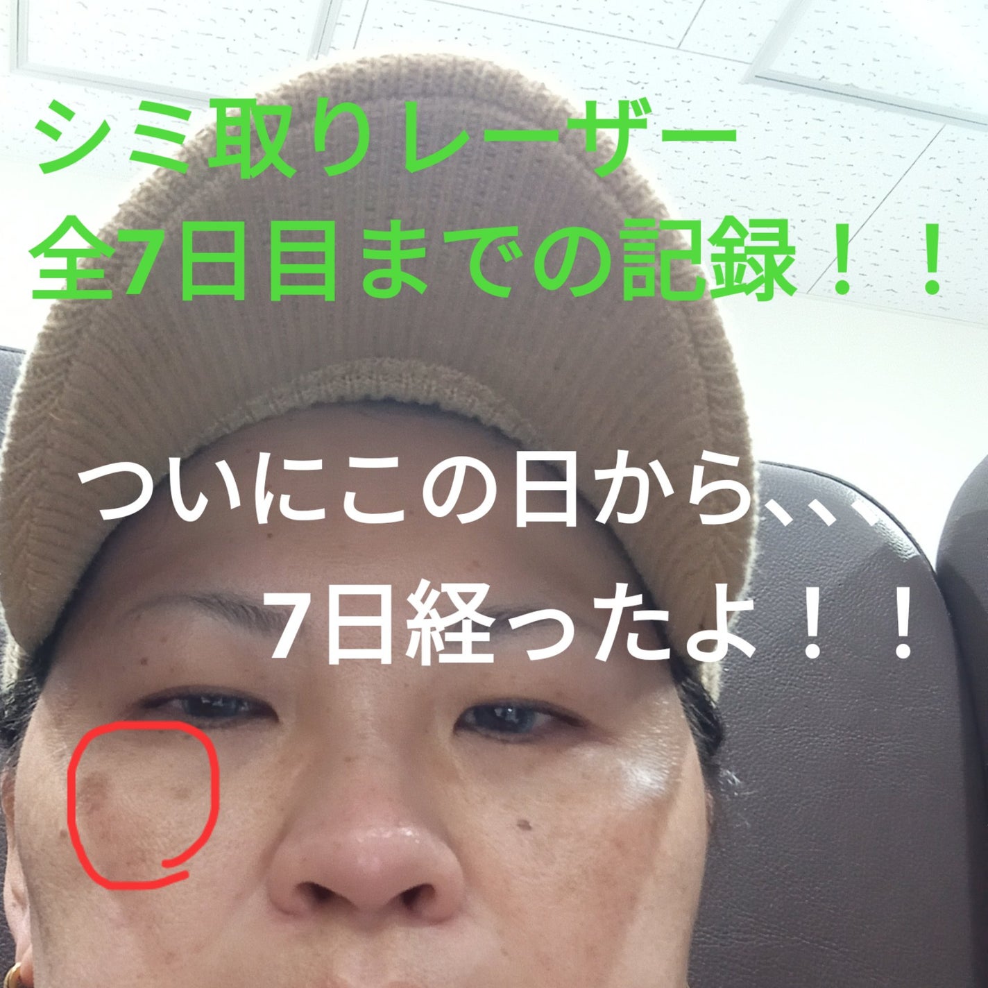 ビヨンセ奥二重向上委員長🥸LIPSパートナー🥳 on LIPS 「ついに!!この時が🤣🩷シミ取りレーザー全記録です🙌🙌🙌(五日目..」(1枚目)