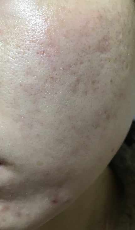 miina@汚肌工事録⚠️ on LIPS 「#ニュースキン #Agelocブースト自分記録⚠️汚肌注意12..」(4枚目)