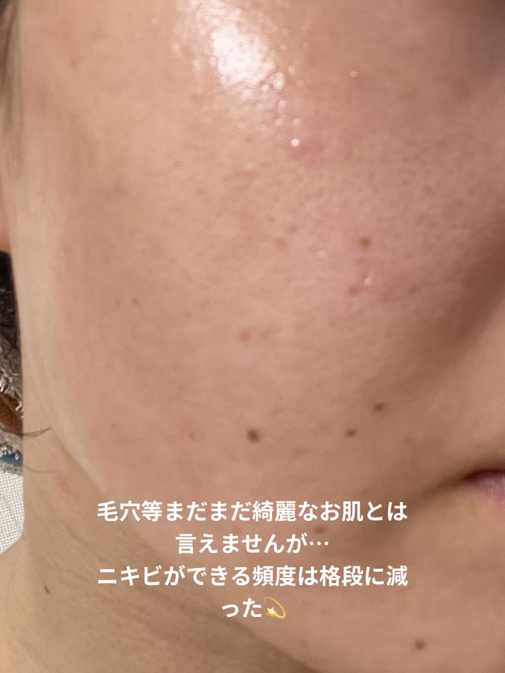 モイスチュア ローション/カルテHD/化粧水を使ったクチコミ（3枚目）