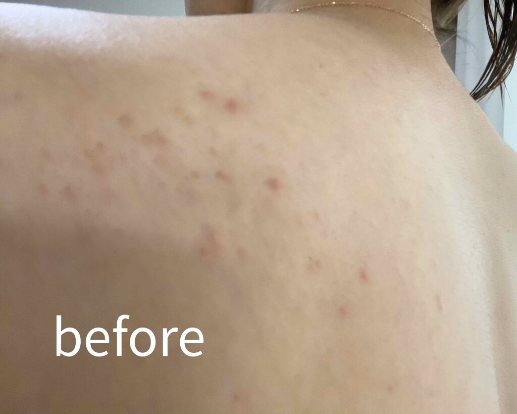 ロゼット洗顔パスタ アクネクリア/ロゼット/洗顔フォームを使ったクチコミ（2枚目）