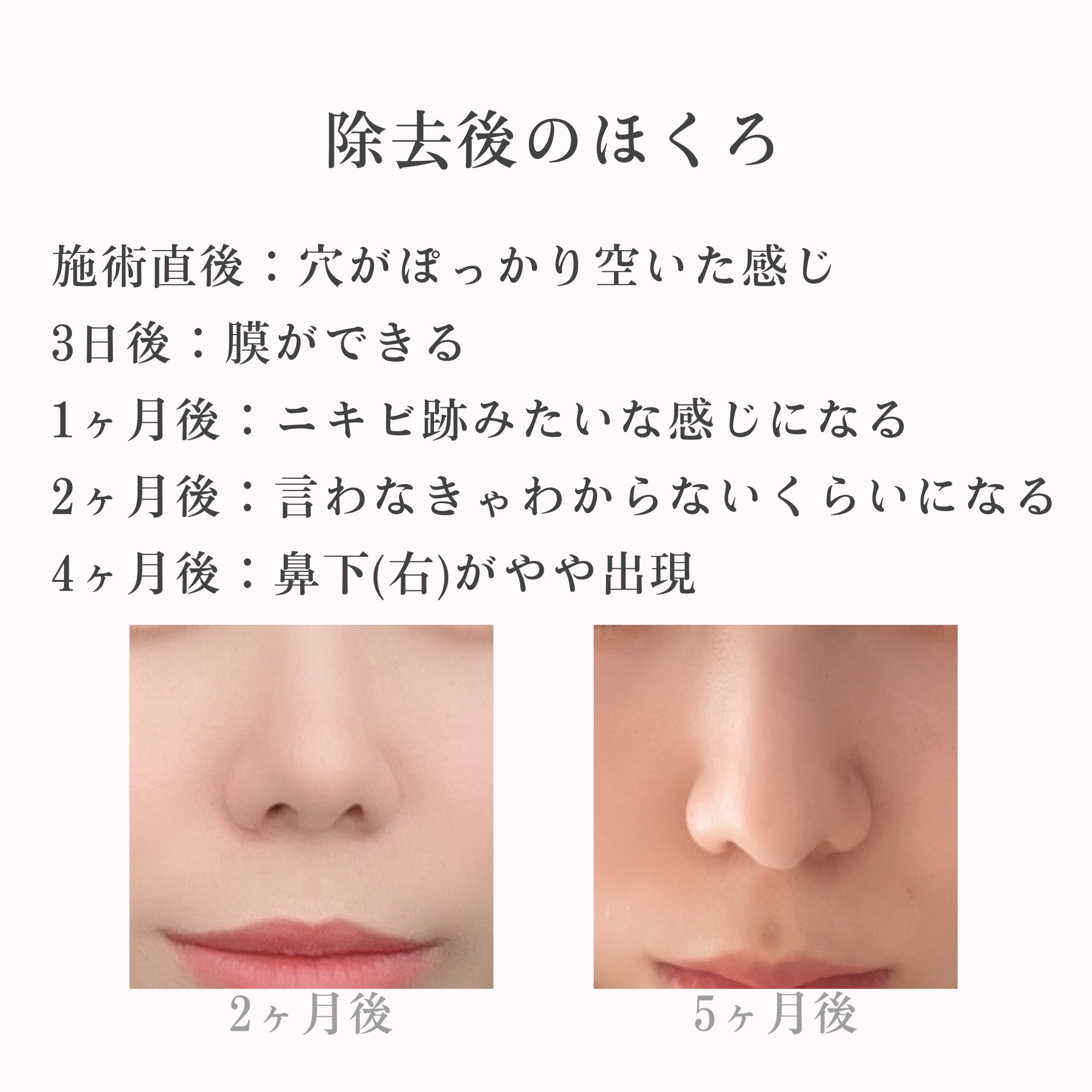 白潤プレミアム 薬用浸透美白乳液/肌ラボ/乳液を使ったクチコミ（3枚目）