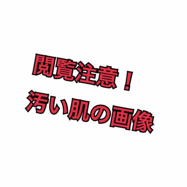 中学の頃からニキビができまくって潰した結果自業自得の肌に。

ビーグレンを頼んでみたので変化が見たいけど自分のフォルダに残したくないのでここに観察用として載せるだけです。
#はじめての投稿