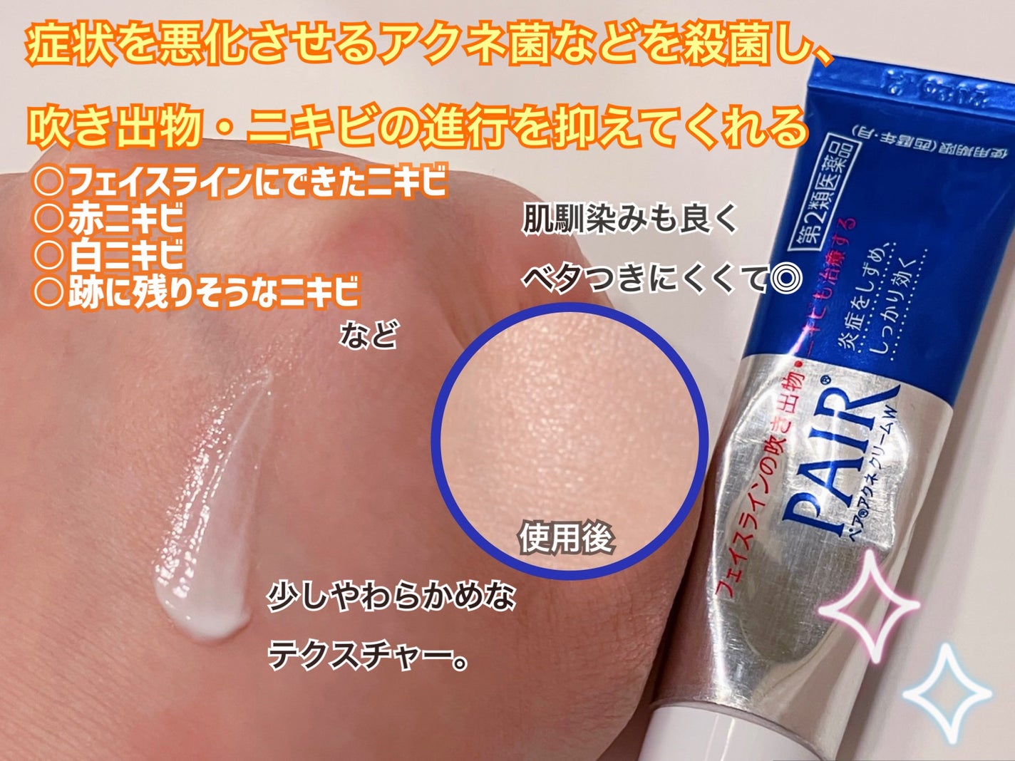 ペアアクネクリームW(医薬品)/ペア/その他を使ったクチコミ(2枚目)