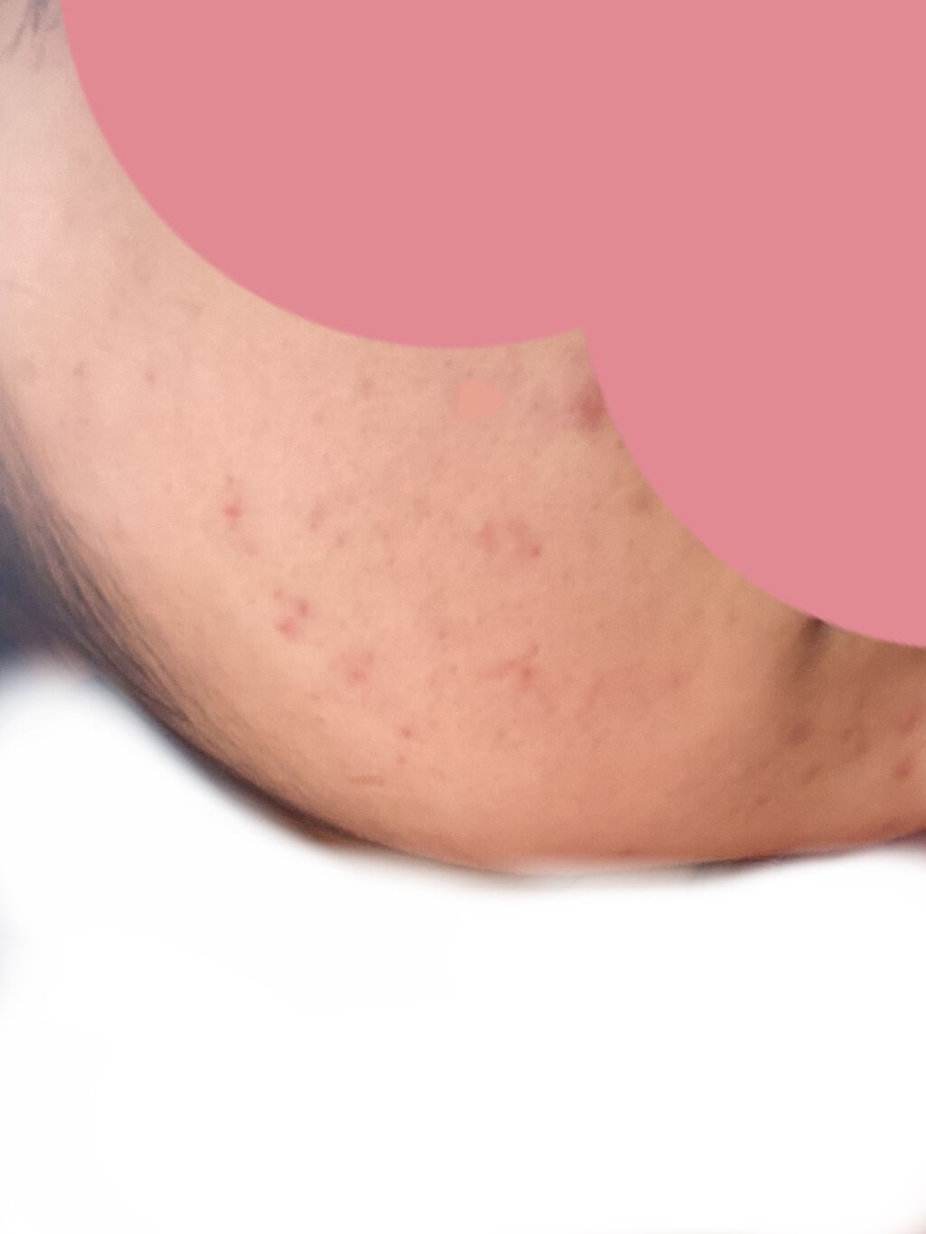 薬用ニキビケア ローション（思春期用）/アクネスラボ/化粧水を使ったクチコミ（3枚目）