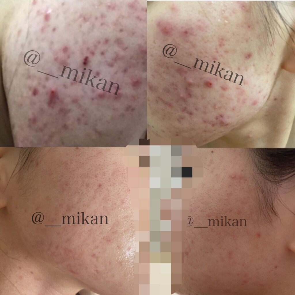 スキンピールバー ティートゥリー/サンソリット/洗顔石鹸を使ったクチコミ（2枚目）