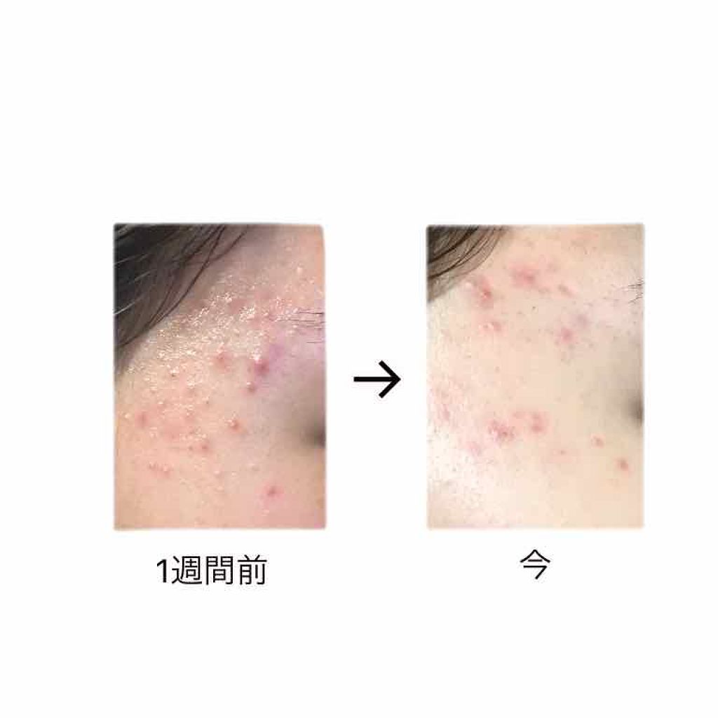 広目天 on LIPS 「⚠️4枚目閲覧注意ですニキビが治らずいろんな「ニキビに効く!」..」(4枚目)