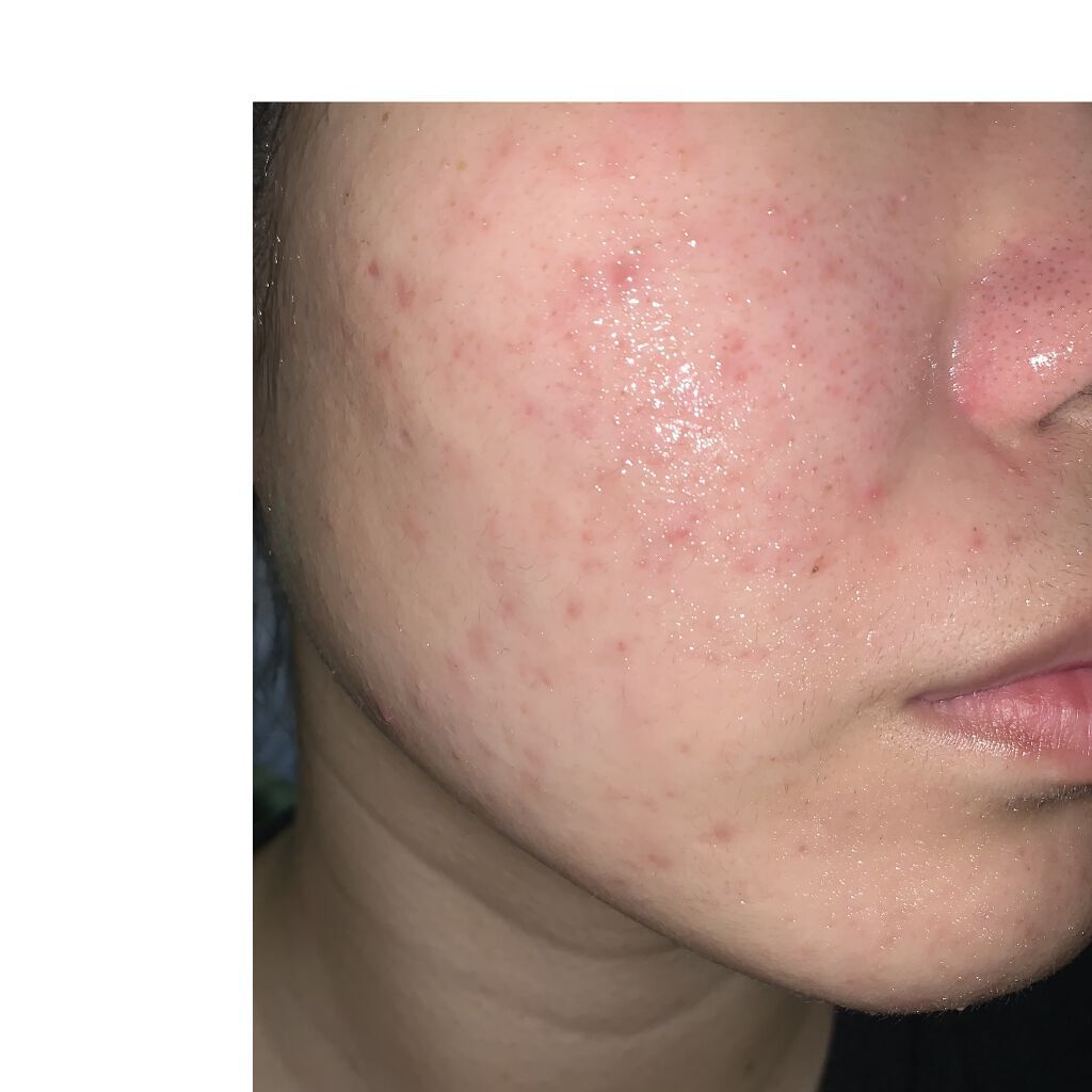 薬用しみ対策 美白化粧水/メラノCC/化粧水を使ったクチコミ（2枚目）