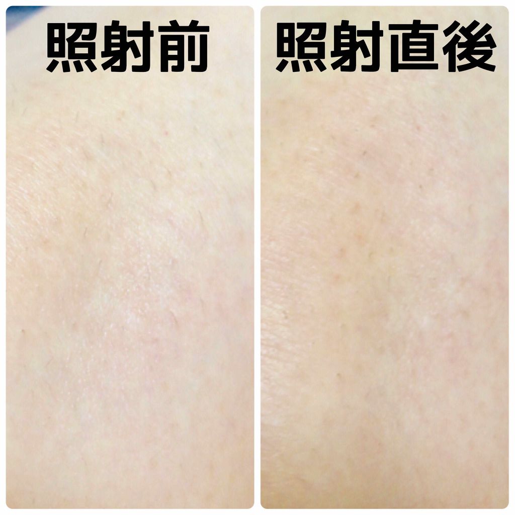 光美容器KE-NON(ケノン)/エムテック/家庭用脱毛器を使ったクチコミ(2枚目)