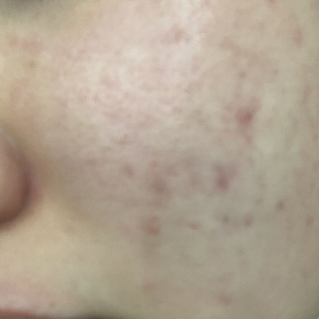 クリンダマイシンゲル(医薬品)/クラシエ薬品/その他を使ったクチコミ（1枚目）