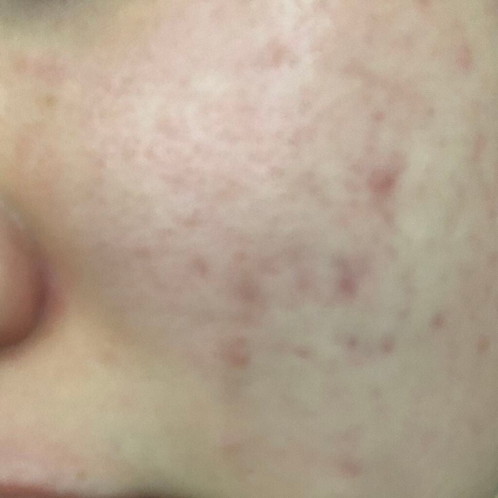 space on LIPS 「行事が始まり、ストレスでニキビが増え、、、疲れと生理ででお菓子..」(1枚目)