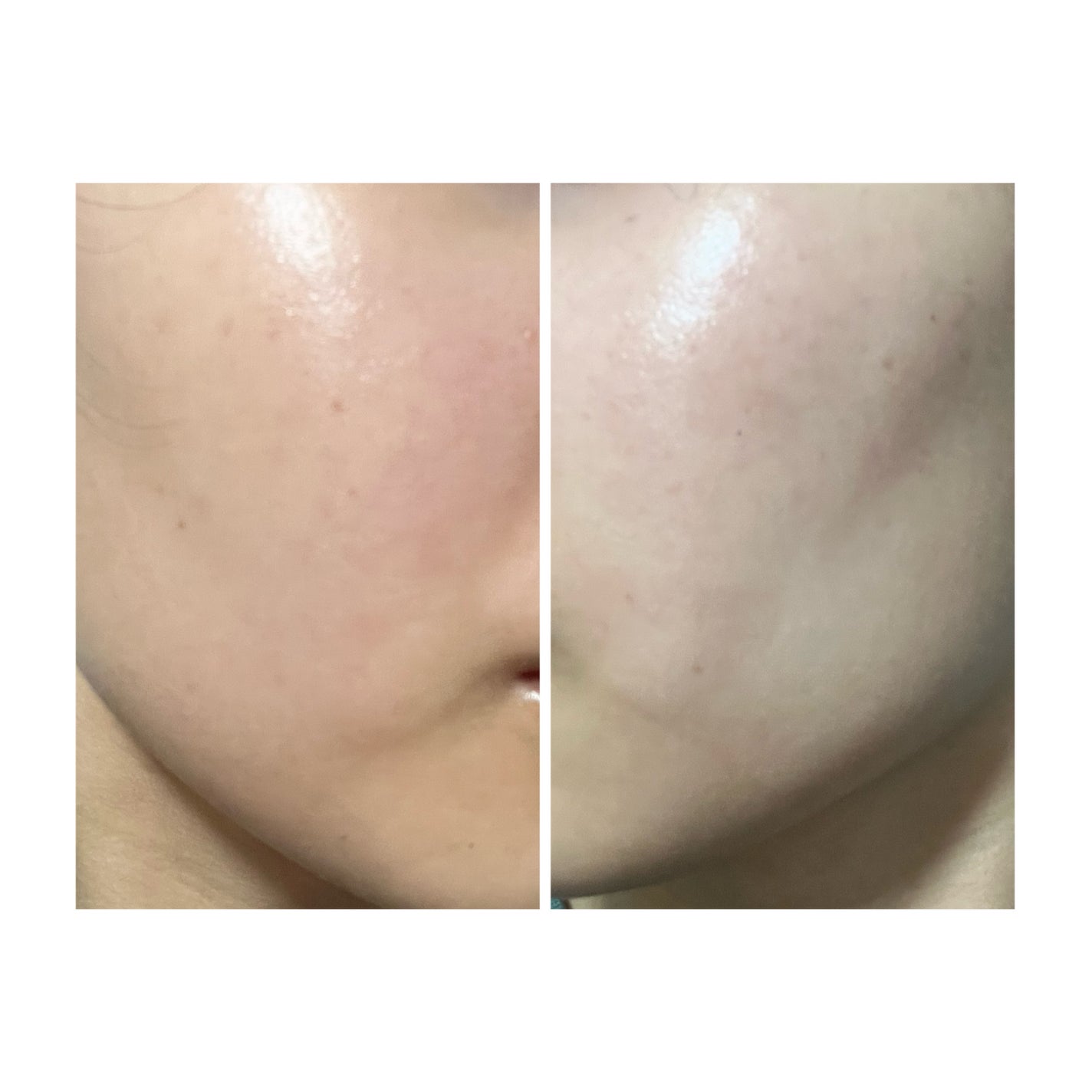 ぽむ on LIPS 「2023.9.13皮膚科に受診 エピデュオとヘパリン処方1枚目..」(3枚目)