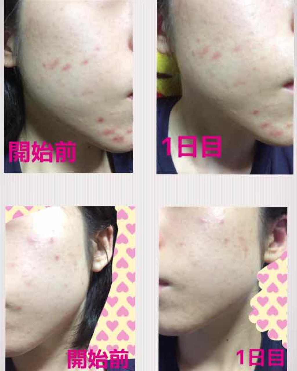 薬用 しみ 集中対策 美容液/メラノCC/美容液を使ったクチコミ（2枚目）