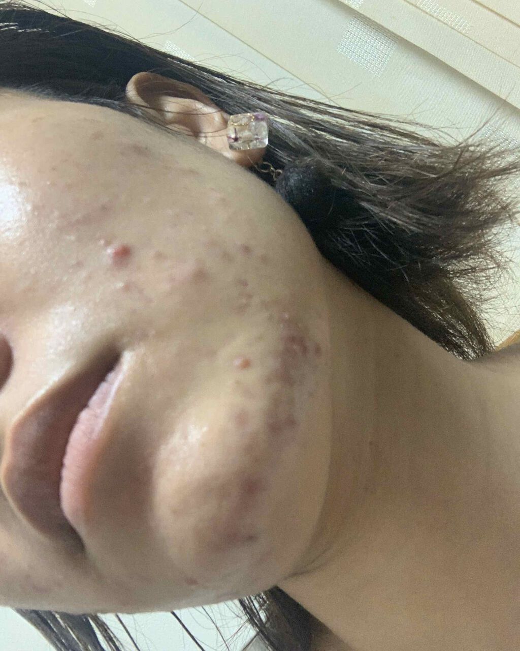 ビーソフテン ローション(医薬品)/持田製薬/その他を使ったクチコミ（1枚目）