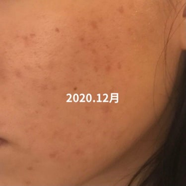 無印良品 敏感肌用薬用美白美容液のクチコミ「こんにちは🌞
現在高校三年生のあいゆと言います

わたしは小学生の高学年らへんからニキビが急に.....」（3枚目）