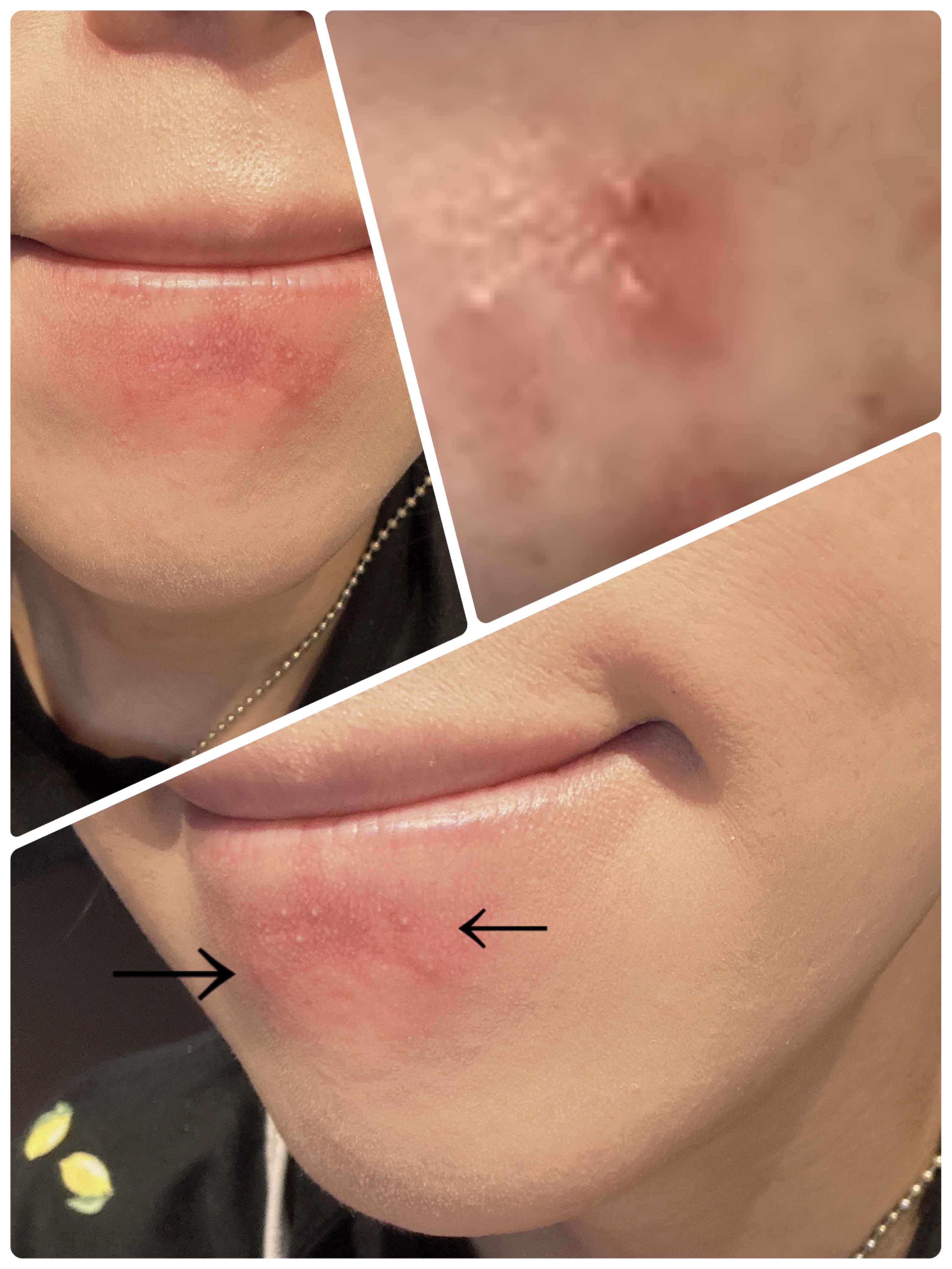 ピンクティーツリーカバーアップグロウクッション/APLIN/クッションファンデーションを使ったクチコミ（1枚目）