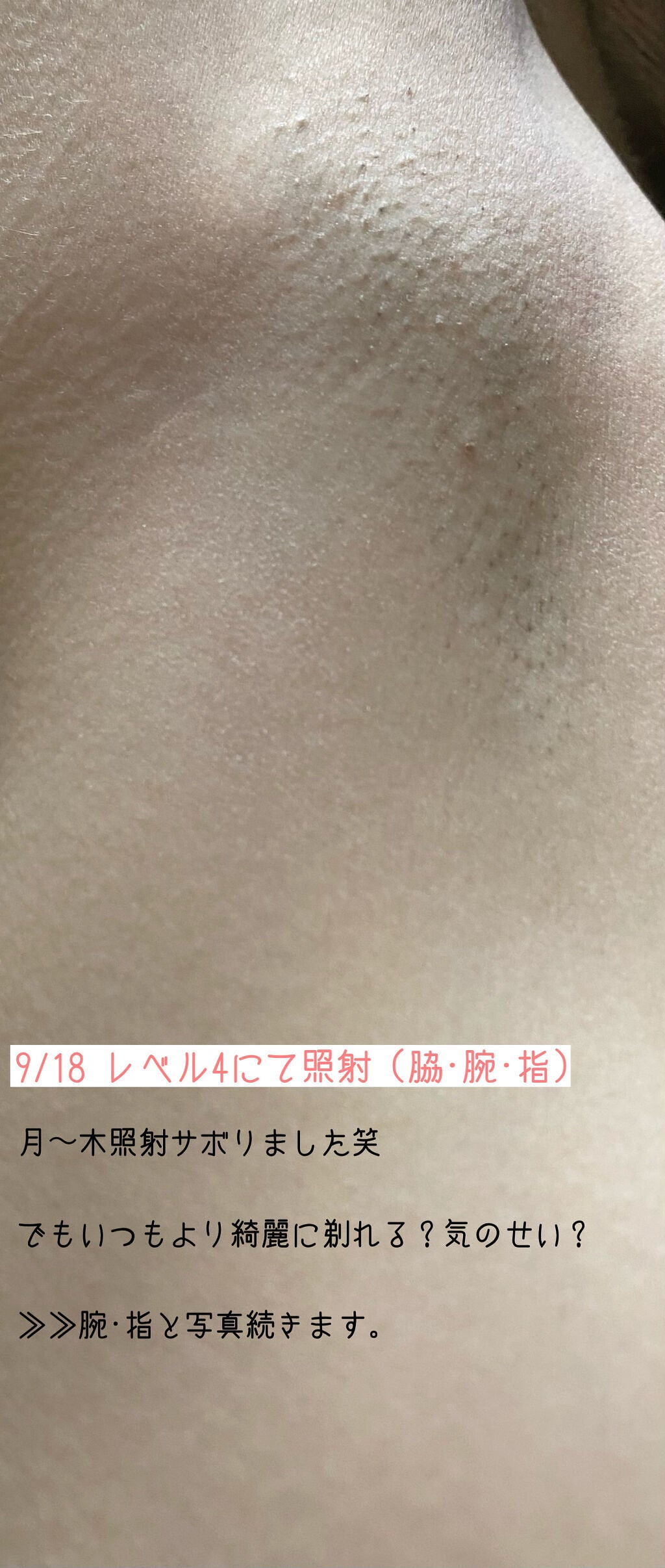 アイスレディ/icelady/家庭用脱毛器を使ったクチコミ(5枚目)