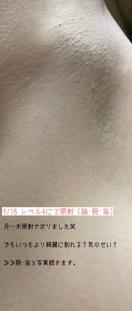 アイスレディ/icelady/家庭用脱毛器を使ったクチコミ(5枚目)