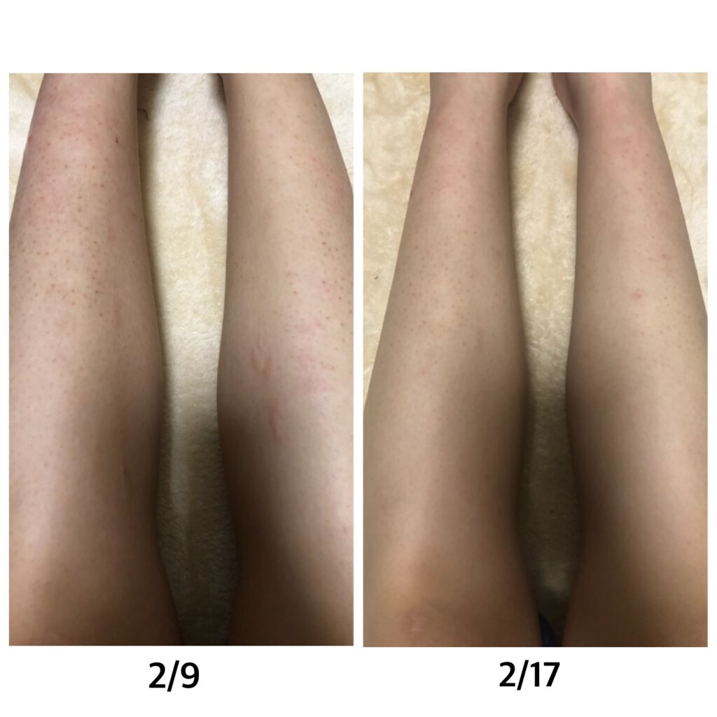 ケアノキュア（医薬品）/小林製薬/その他を使ったクチコミ（2枚目）