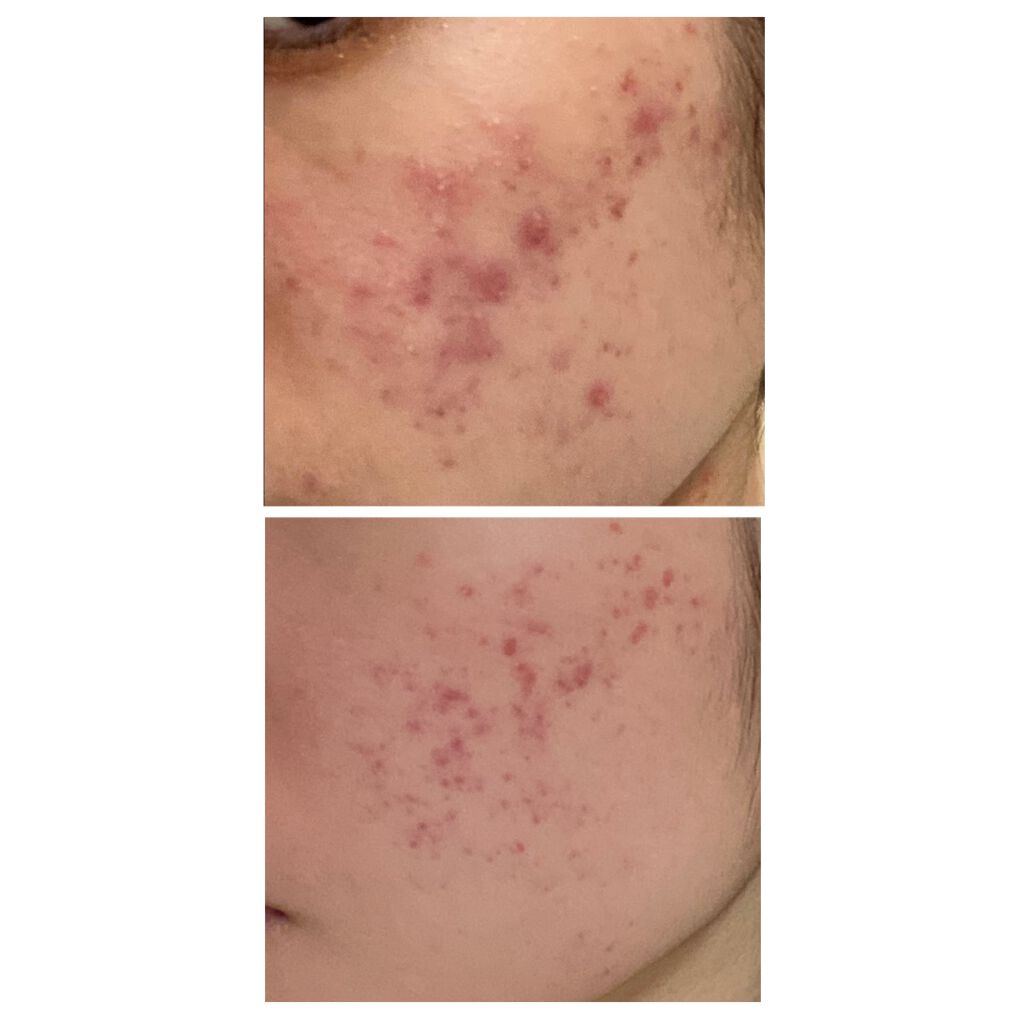 01_ringo_01 on LIPS 「上の写真が1日目、下の写真が薬を塗り始めて77日目💊肌の凹凸は..」(3枚目)