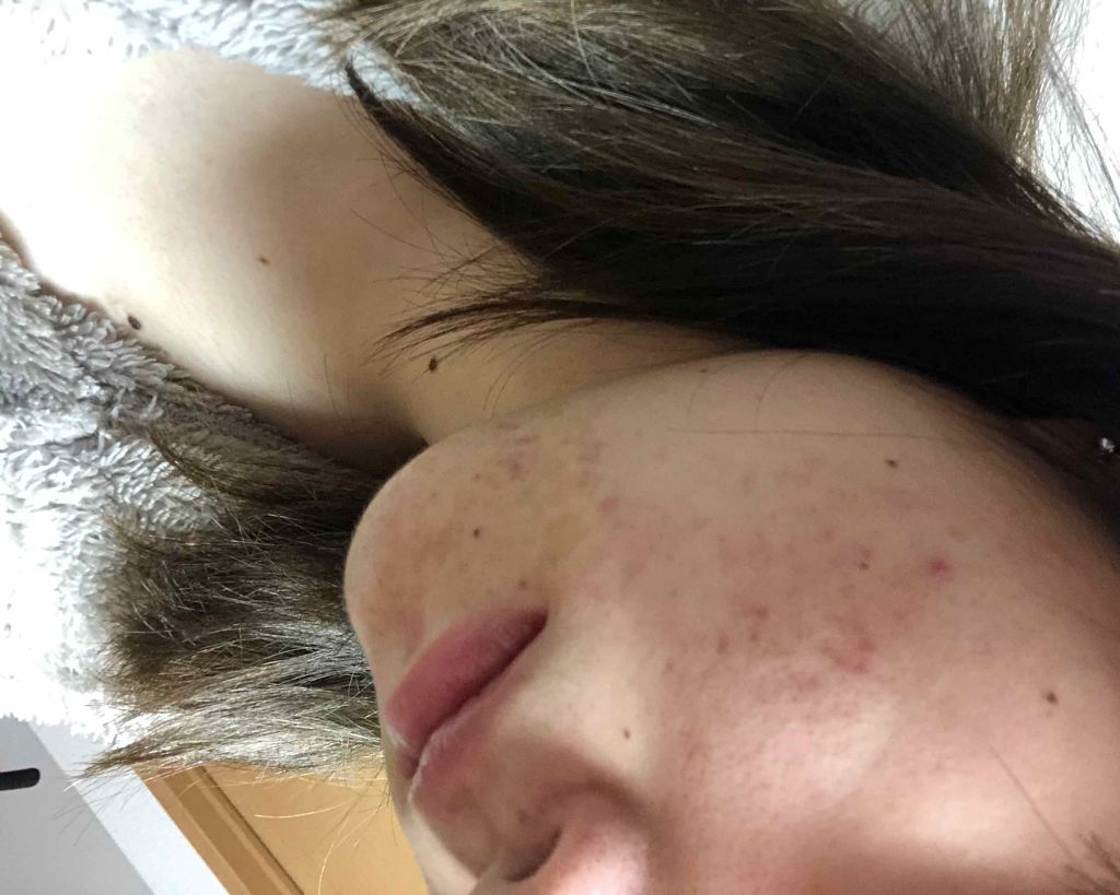 マンスリースキンケアプログラム(旧)/APEX/スキンケアキットを使ったクチコミ（3枚目）