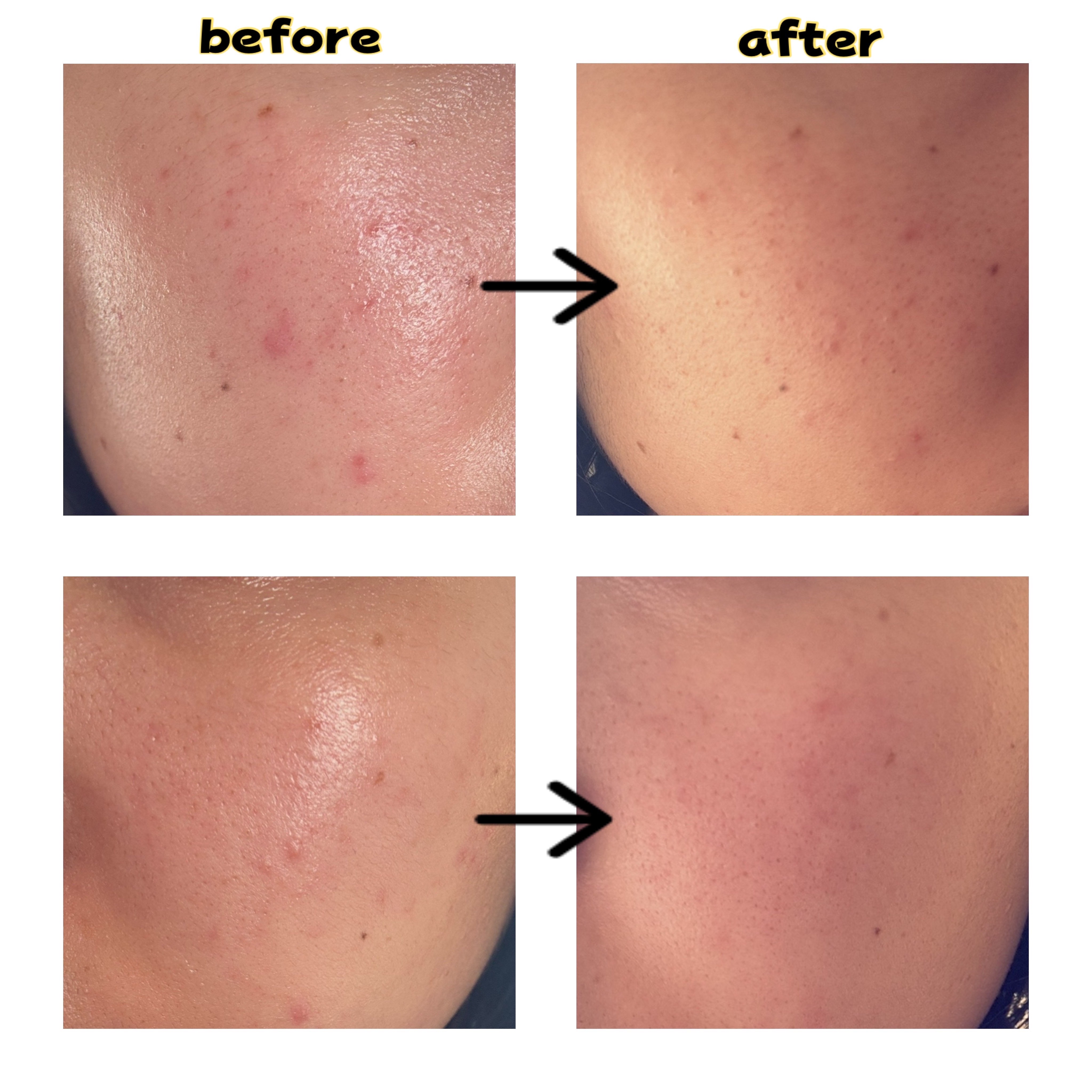 薬用しみ集中対策 プレミアム美容液/メラノCC/美容液を使ったクチコミ（3枚目）