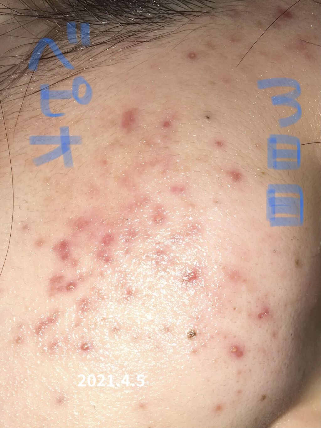 ベピオゲル/マルホ株式会社/その他を使ったクチコミ（2枚目）