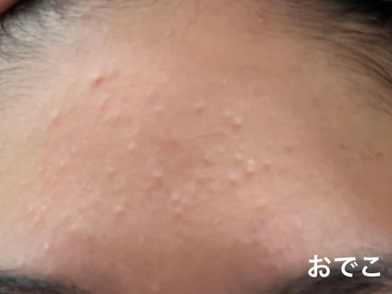 ニキビ治療薬(医薬品)/メンソレータム アクネス/その他を使ったクチコミ(5枚目)