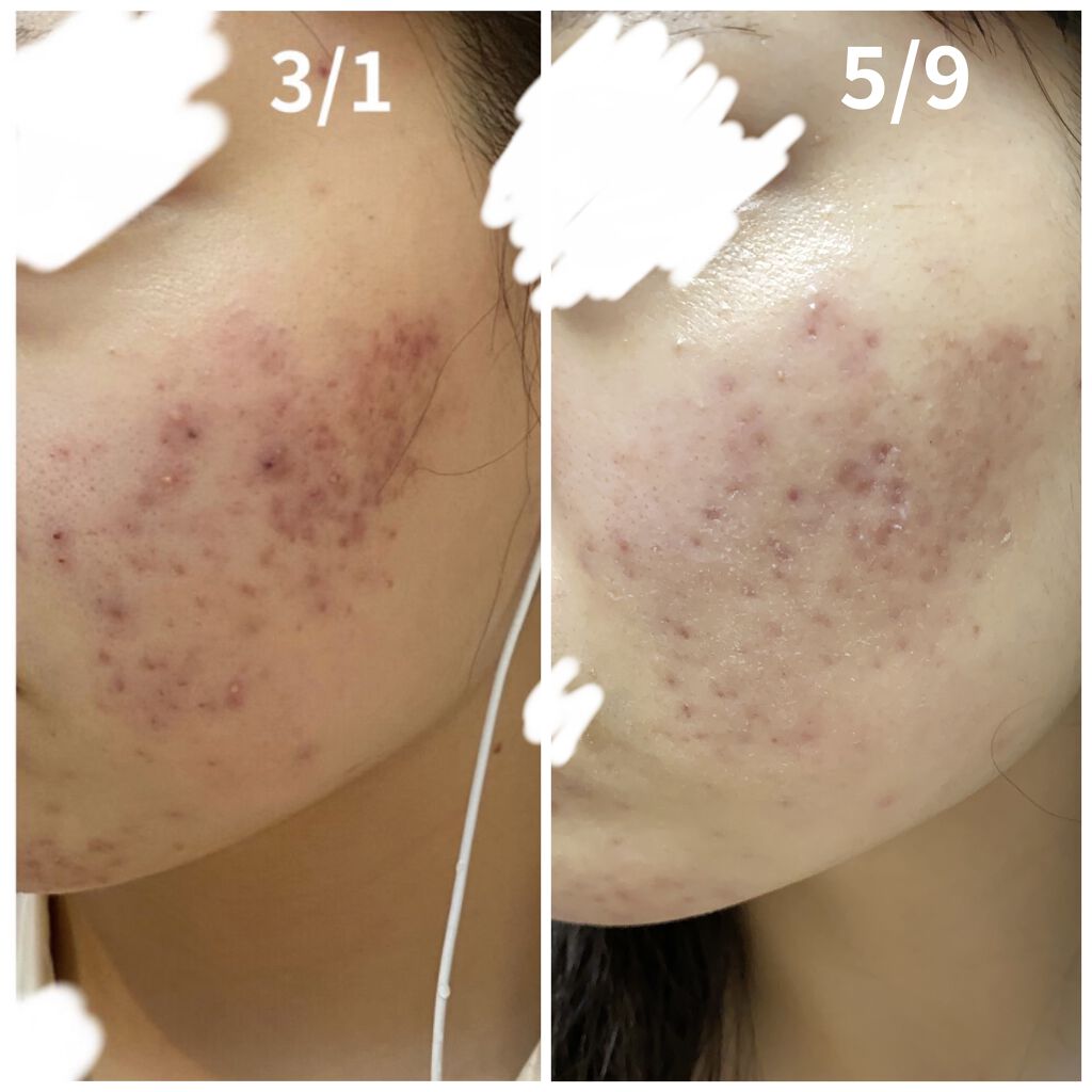 ノブ Ａ アクネソープ/NOV/洗顔石鹸を使ったクチコミ（3枚目）