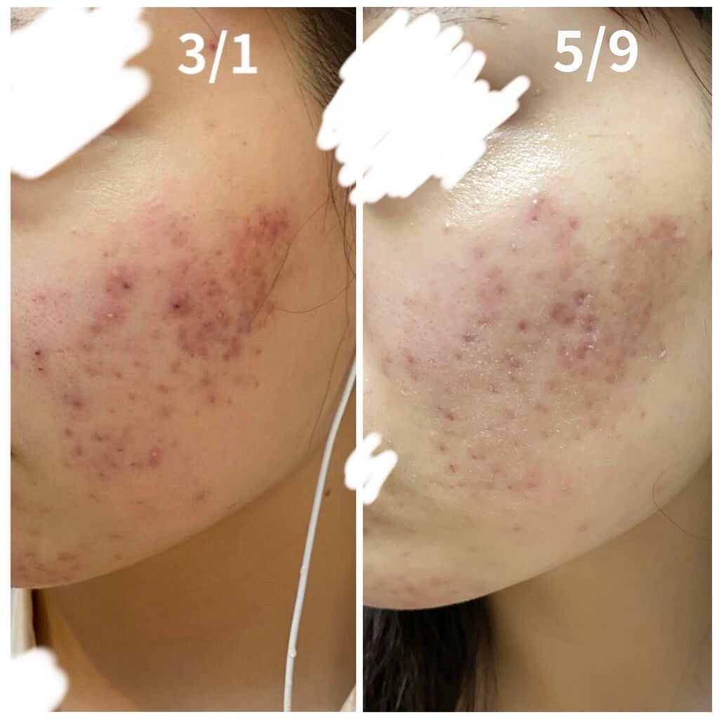 ノブ A アクネソープ/NOV/洗顔石鹸を使ったクチコミ(3枚目)