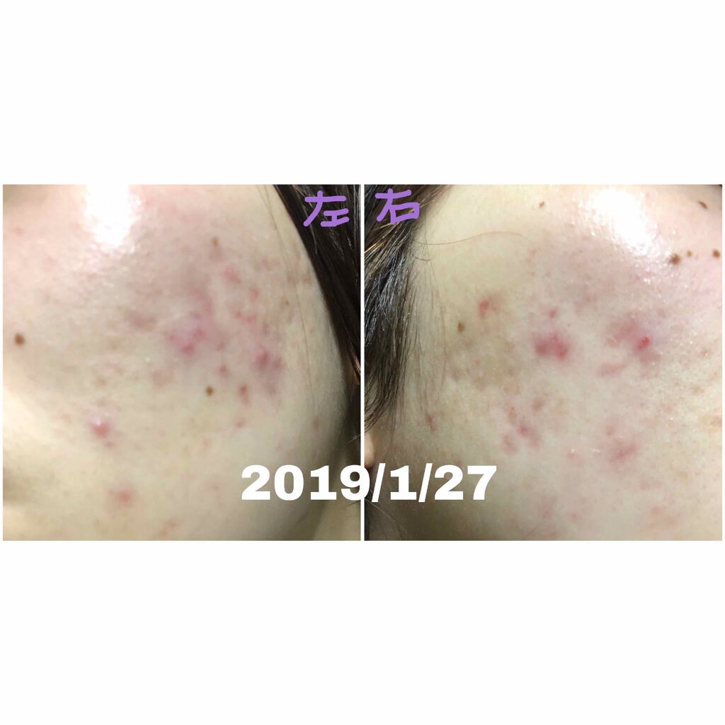 こつめ on LIPS 「肌経過記録✍🏻(🚨閲覧注意)仕事上マスク必須なせいか、どんどん..」(2枚目)