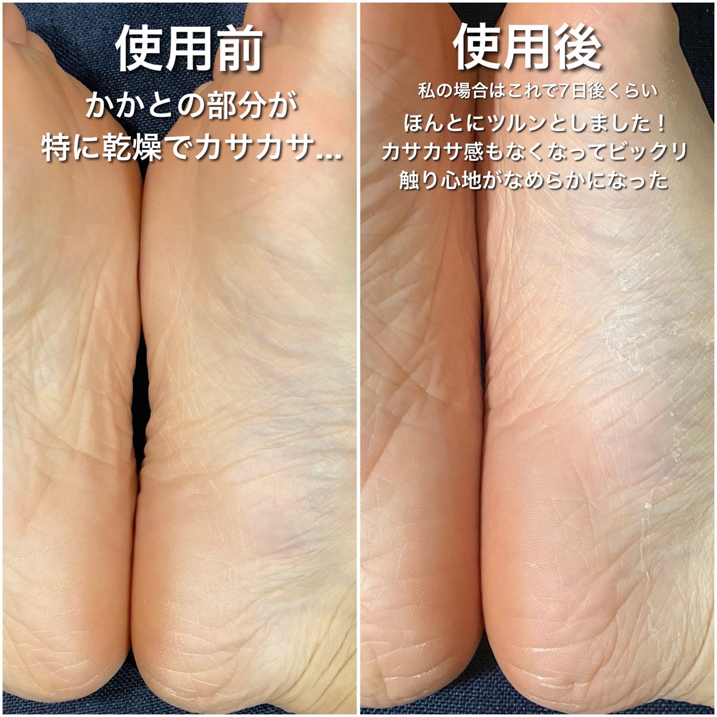 イージーパックDP60分タイプ/ベビーフット/レッグ・フットケアを使ったクチコミ(3枚目)