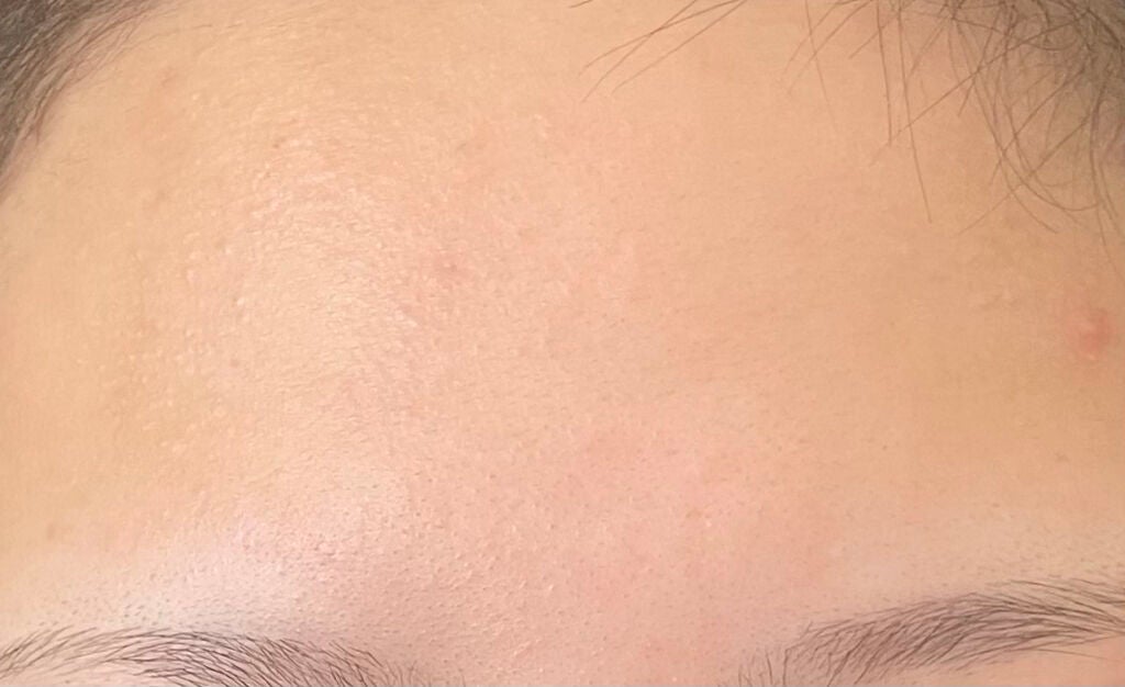 オードムーゲ 薬用ローション(ふきとり化粧水)/オードムーゲ/拭き取り化粧水を使ったクチコミ(5枚目)