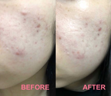 ゼロスポットパッチ/Today’s Cosme/にきびパッチを使ったクチコミ(3枚目)