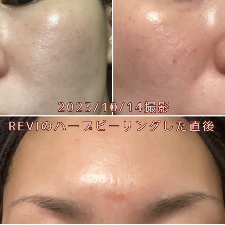 Rifa on LIPS 「※観覧注意⚠️肌載せてます。最近話題のREVIのハーブピーリン..」(3枚目)