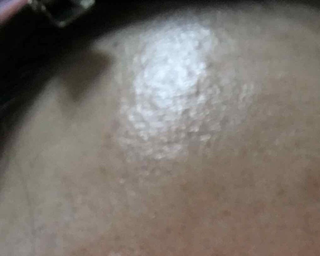 かな on LIPS 「全然投稿してませんでしたが写真は今の肌の状態です1ヶ月アキュテ..」(2枚目)