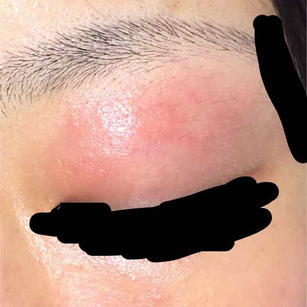 柚月 on LIPS 「※治療中の写真あります。赤みやただれかけている画像もありますの..」(2枚目)