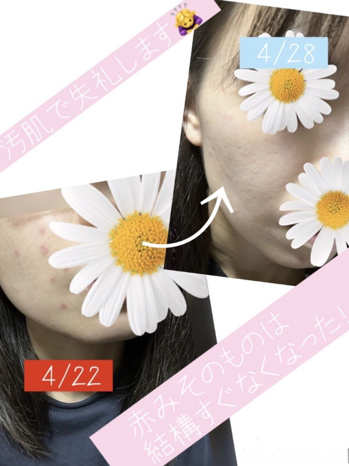 ペアアクネクリームW(医薬品)/ペア/その他を使ったクチコミ（3枚目）