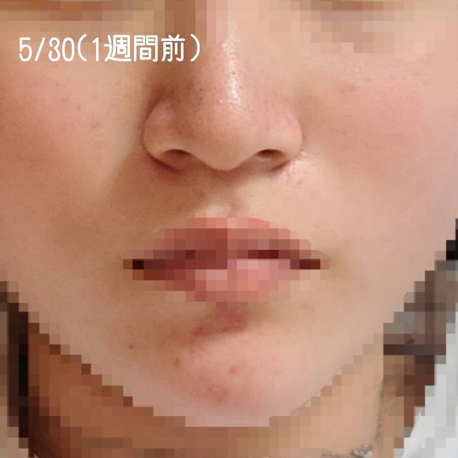 umi on LIPS 「"ニキビ肌女子の肌経過"自分の肌を投稿するのはとても迷いました..」(4枚目)