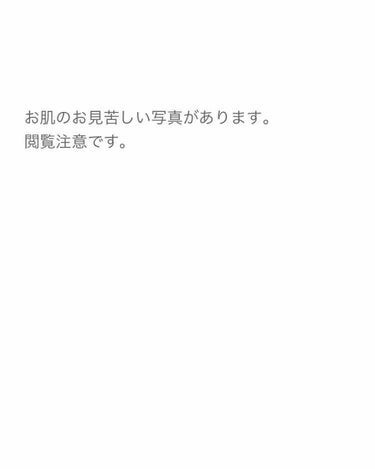 カウブランド 赤箱 (しっとり)のクチコミ「こんにちは。

高校一年生からずっと肌荒れに悩まされてきて、皮膚科に通っても治らなかったニキビ.....」（1枚目）