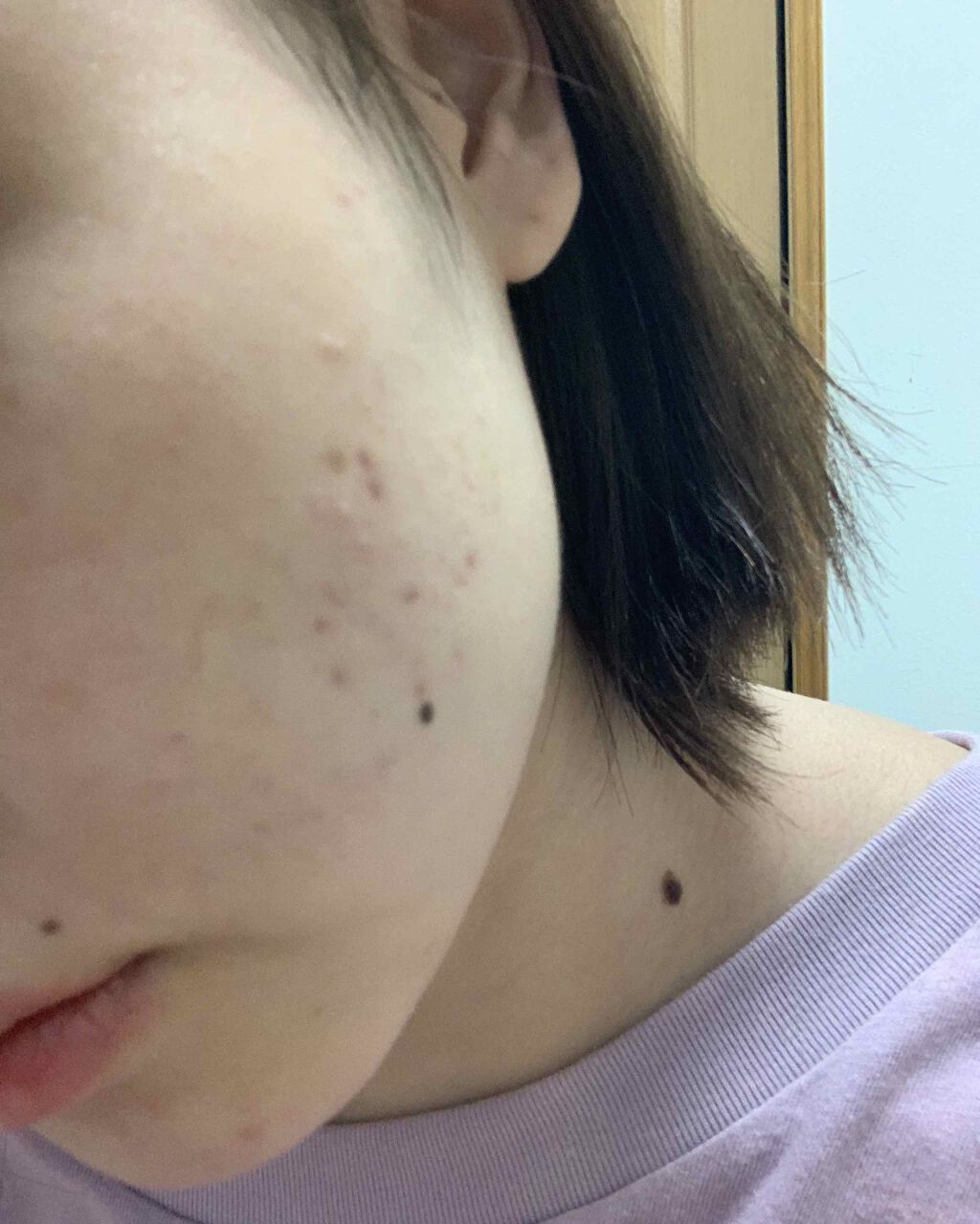 デュアック配合ゲル/ポーラファルマ/その他を使ったクチコミ（3枚目）