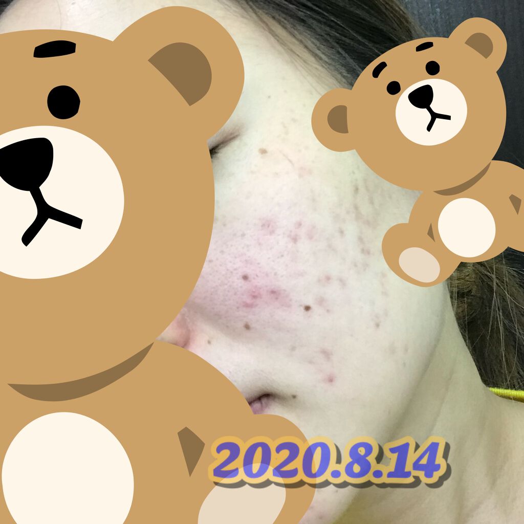 ロゼット洗顔パスタ アクネクリア/ロゼット/洗顔フォームを使ったクチコミ(2枚目)