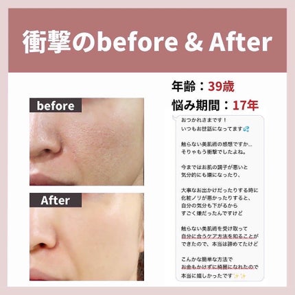 あなたの肌に合ったスキンケア💐コーくん先生 on LIPS 「【驚愕】9割が知らない毛穴を1日で消す方法🤫...あなたの毛穴..」(4枚目)