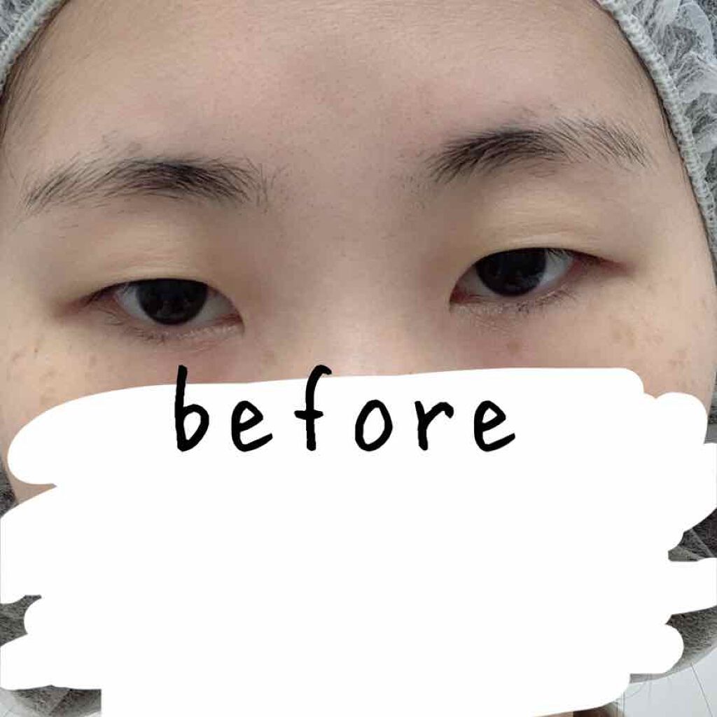 二重整形の口コミ はじめまして 湘南美容クリニックで二重整形をしてきましたのでレポします By さとう Lips 二重整形の口コミ はじめまして 湘南美容クリニックで二重整形をしてきましたのでレポします By さとう Lips