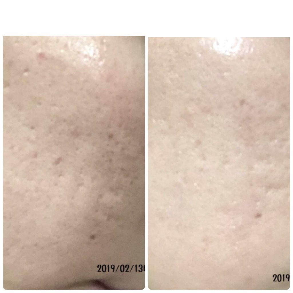 7 day Special Set プログラム3/b.glen/トライアルキットを使ったクチコミ(2枚目)