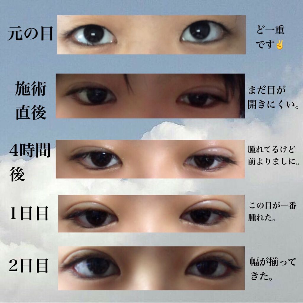 二重整形の口コミ 二重埋没dt10日間のまとめ 初投稿で By 白 脂性肌 10代後半 Lips