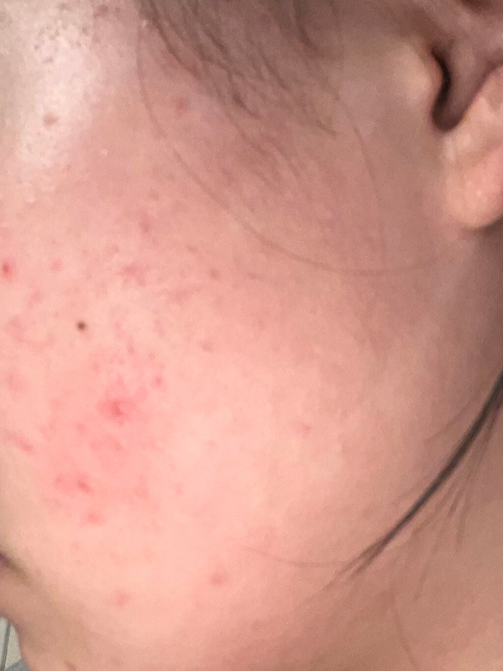 パピコ on LIPS 「ニキビ日記3日目今日も良くなった様子はなしです…食生活には気を..」(3枚目)