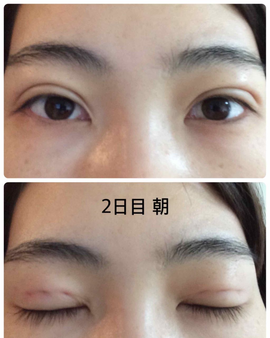 ゆき on LIPS 「整形2日目です!腫れは夜になるにつれて、だんだん引いてきました..」(2枚目)