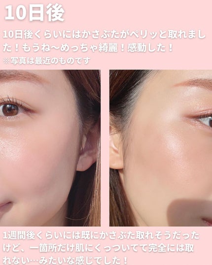 mii♡イエベ春🌸フェミニン on LIPS 「シミとりレーザー感想と経過をまとめました💁🏻♀️✨同じ悩みの..」(7枚目)