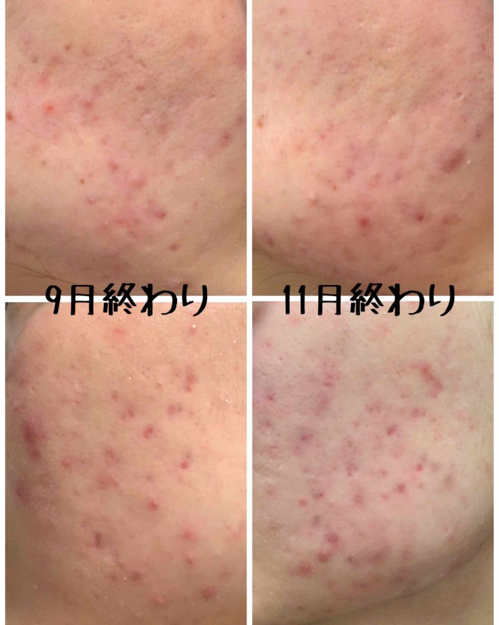 まな on LIPS 「⚠️2枚目に汚い肌の写真がありますどうも。2ヶ月ぶりに比較をし..」(2枚目)