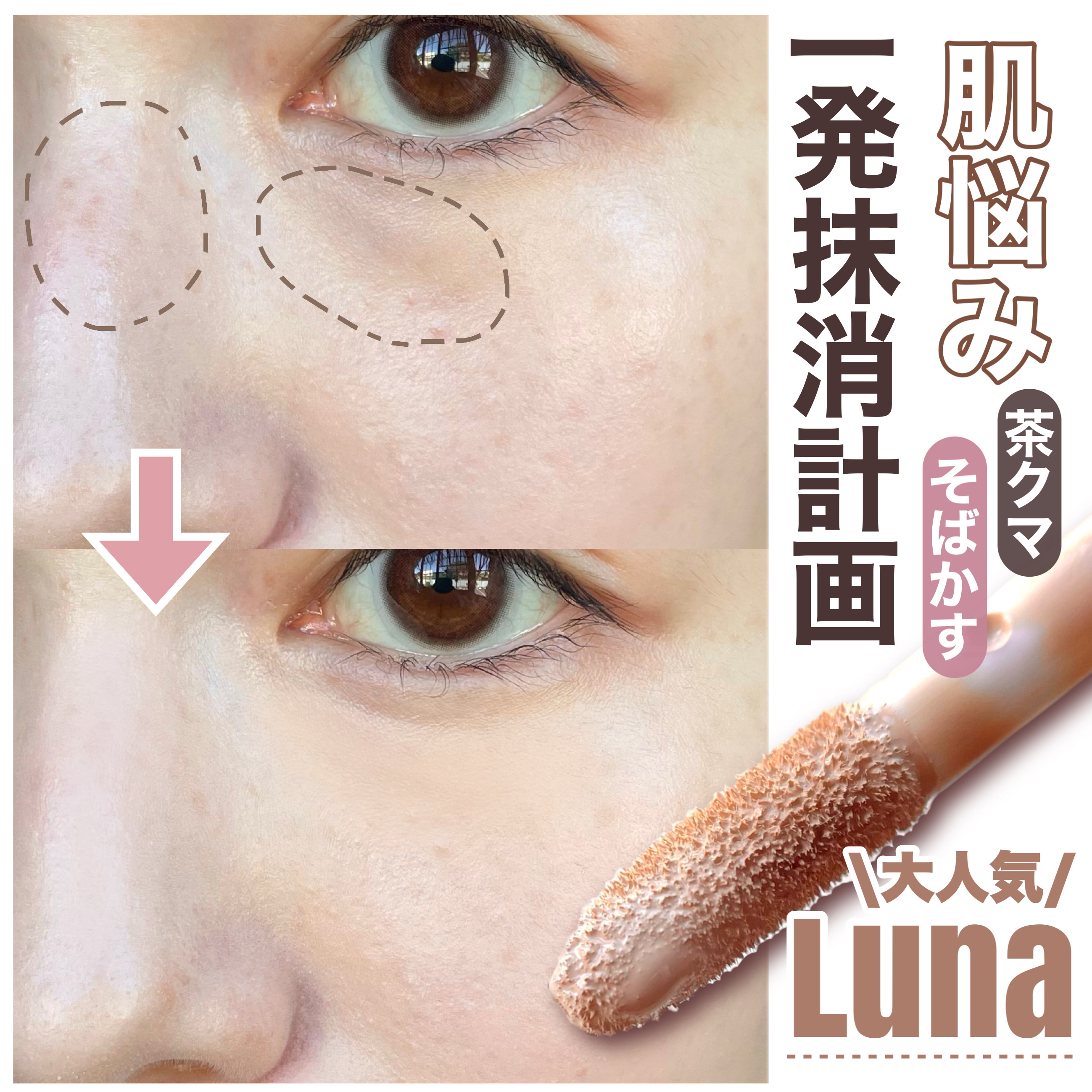 ロングラスティングチップコンシーラーフィックシングフィット/LUNA/リキッドコンシーラーを使ったクチコミ（1枚目）